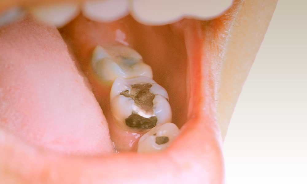 терапевтическая стоматология - пломбирование
